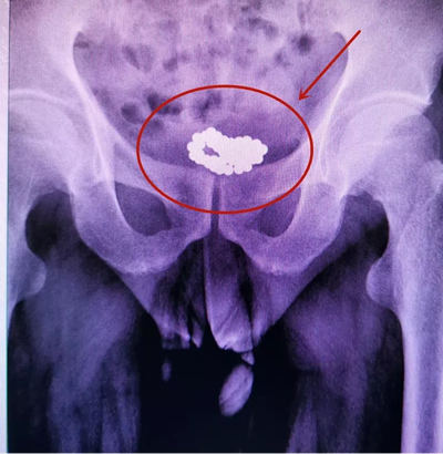 四川省生殖健康研究中心附属生殖专科医院泌尿外科成功从患者膀胱里取出58颗磁力珠