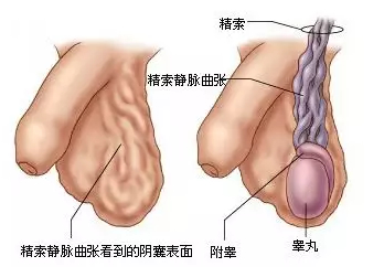 四川成都生殖专科医院男科张辉医生:男性不育与精索静脉曲张