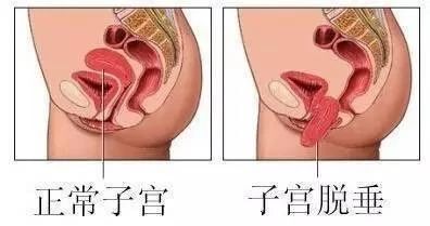 成都中医大附属医院泌尿外科张永华:关注女性盆底健康