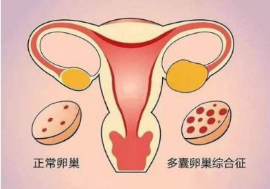 成都女性多囊卵巢检查项目有哪些？怎么查出来多囊？