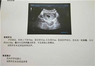花费十多万求子无果,苦熬多年 来四川省生殖健康研究中心附属生殖专科医院喜获好孕